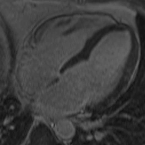 Cardiac MRI of Lyme disease myocarditis | Heart
