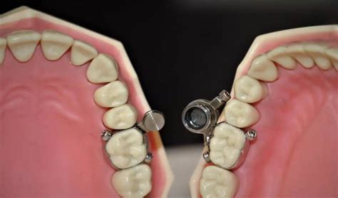 Weight-Loss Device : ఇదో సరికొత్త డివైజ్.. బరువు తగ్గాలంటే.. నోటికి ...