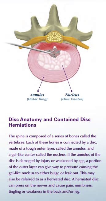 Image result for Disc FX Procedure