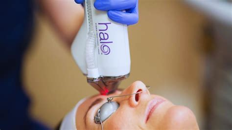 Halo Laser Treatment: How It Works & What to Expect | TheBeautyFoodie