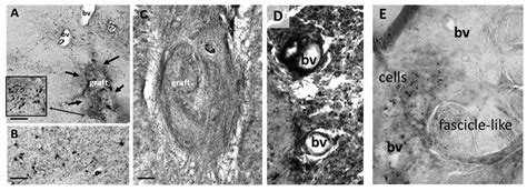 Recipient Reaction and Composition of Autologous Sural Nerve Tissue ...