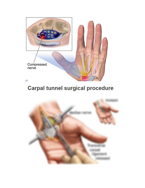 SOLUTION: Surgical treatment for carpal tunnel syndrome carpal tunnel ...