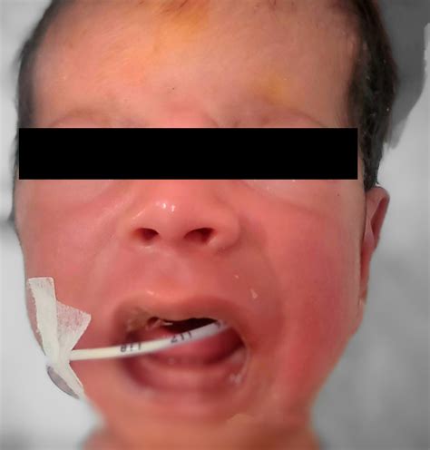 A neonate with erythematous rash over face | Pediatric Oncall Journal