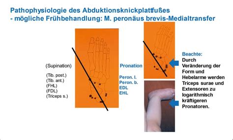Funktionsverbessernde Sehnentransfers am Fuß - Orthopädie ...