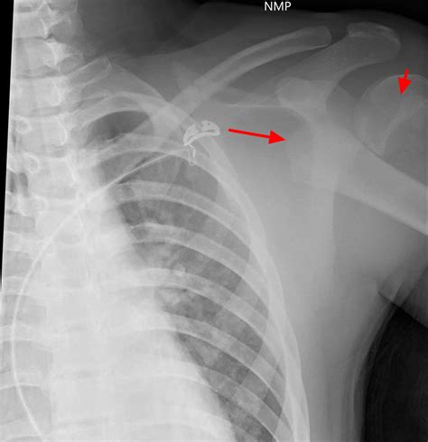 Growth Plate Fracture - Causes, Types, Symptoms,Treatment