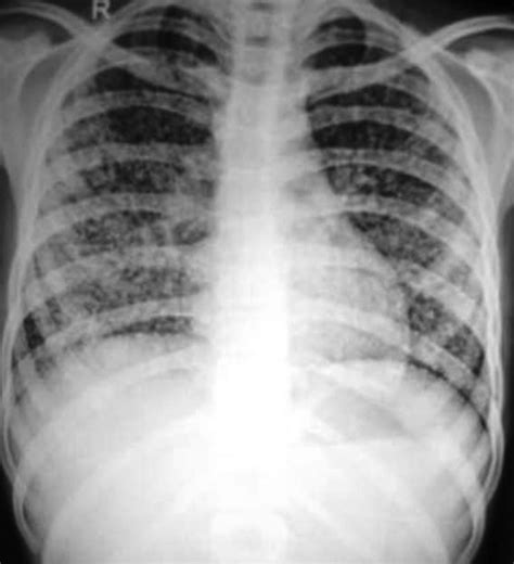 Tuberculosis Vs Pneumonia X Ray