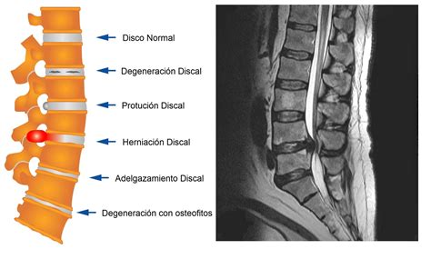 | Tratamiento Hernia Discal | | Tratamiento medico no quirúrgico de la ...