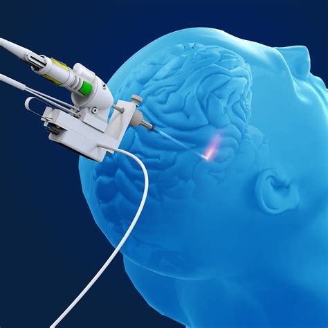 The NeuroBlate® Laser Ablation System | Monteris