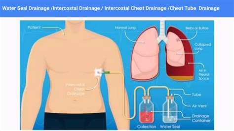Medical surgical nursing topic ,intercostal drainage or water seal ...