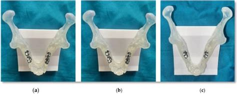 Digital Image Correlation Analysis of Implant Angulation, Splinting ...