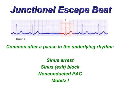 Junctional Rhythms - BMH/Tele | PPT