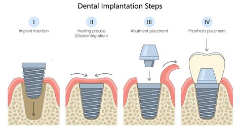 Tooth Implants Procedure 的图像结果