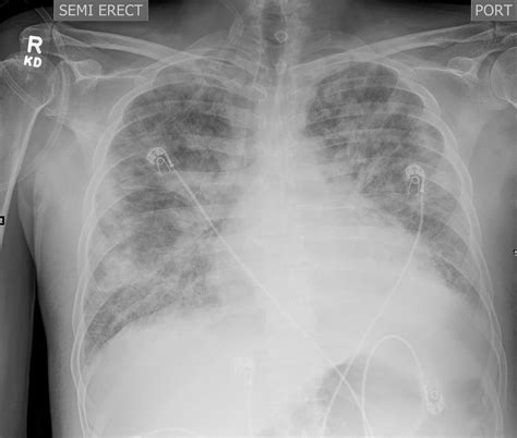 VG Med IF 136502 lungs diffuse multicentric subsegmental consolidation GGO interstitial ...