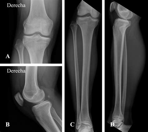 Proximal tibiofibular joint dislocation diagnosis and treatment