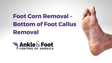 Painful Callus On The Bottom Of My Foot Shop | emergencydentistry.com