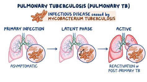 Tuberculosis (pulmonary): Clinical sciences - Osmosis Video Library