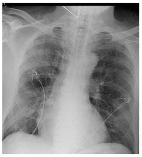 Role of a Chest X-ray Severity Score in a Multivariable Predictive ...