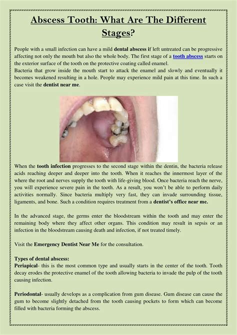 Tooth Abscess Tooth Abscess Complications | Emergency Dentist Adelaide