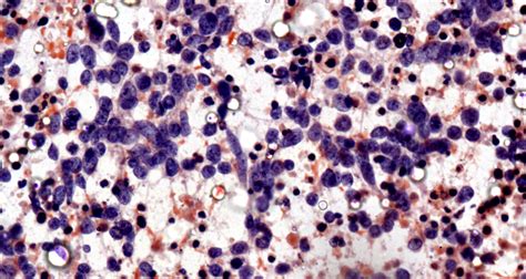 IJPO - Indian J Pathol Oncol