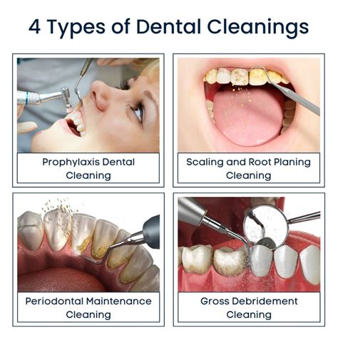 4 Types of Dental Cleanings | Broadway Family and Cosmetic Dentistry