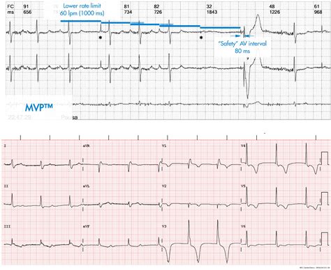 Atrial Pacing