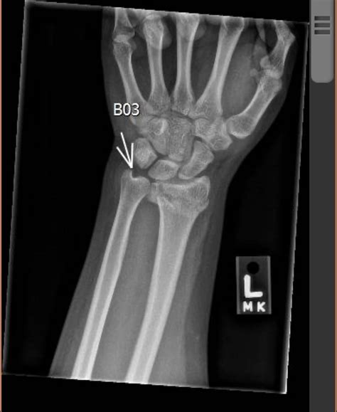 Image result for Fractured Radius