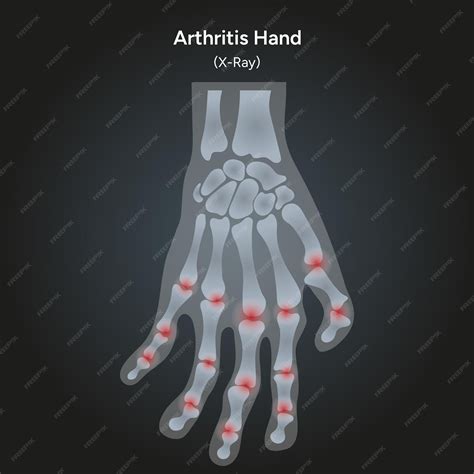 Radiografía de la mano humana para la artritis reumatoide | Vector Premium