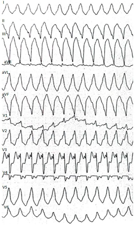 Paroxysmal Sustained Ventricular Tachycardia with Cardiac Arrest and ...