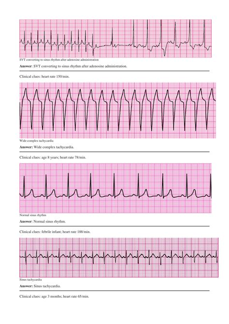 SOLUTION: Pals precourse self assessment answers rhythm - Studypool