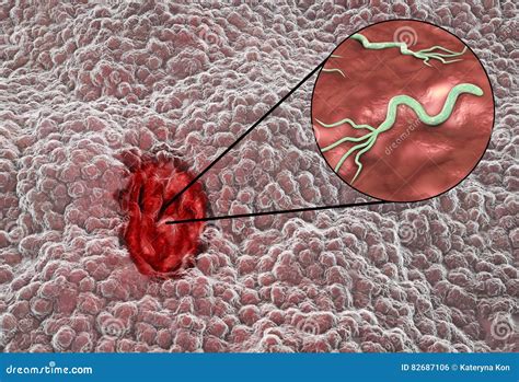 Mucosa of Stomach with Peptic Ulcer and Bacterium Helicobacter Pylori Stock Illustration ...