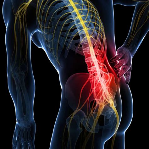 Pinched nerve in lower back: Causes & Treatment of nerve pain