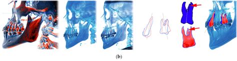 Utilization of a 3D Printed Orthodontic Distalizer for Tooth-Borne ...