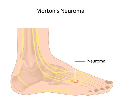 What is Morton’s Neuroma? Causes, Symptoms, and Treatment