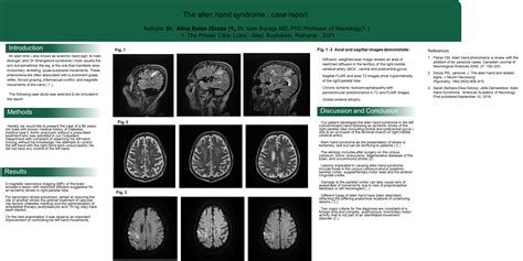 Image result for Alien Hand Syndrome Documentary