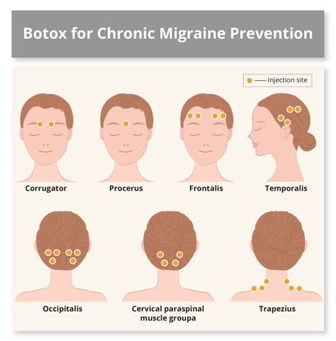 Botox For Migraines Side Effects