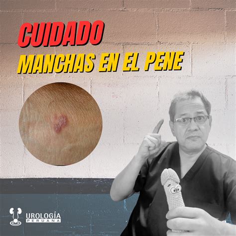 Infección Por Hongos En El Pene