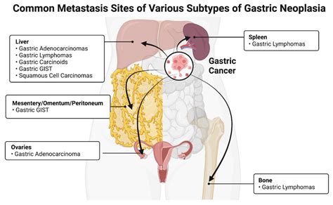 Bacterial Involvement in Progression and Metastasis of Adenocarcinoma of the Stomach