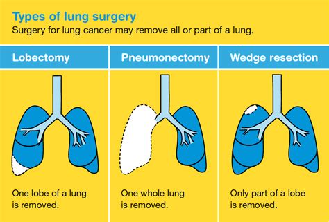Treatment for Lung Cancer - Philadelphia Holistic Clinic - Dr. Tsan