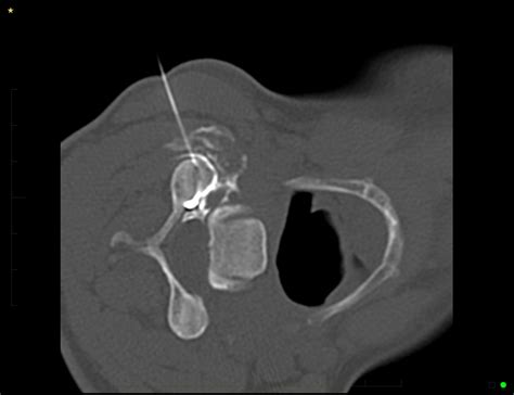 Effective Facet Joint Treatment | Melbourne Radiology