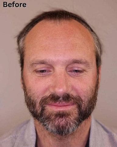 Incredible Grafts Hair Transplant Before and After: Hair Restoration ...