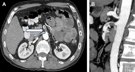 Mesenteric Ischemia - Critical Care Clinics