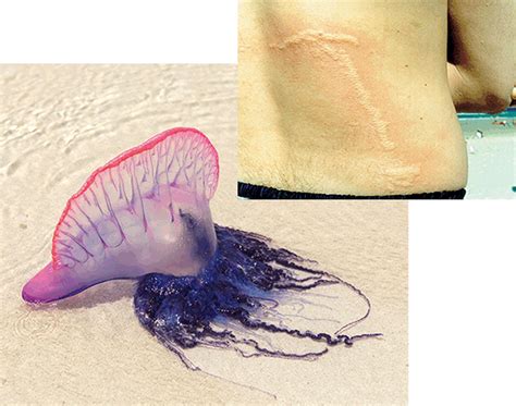 Jellyfish Sting