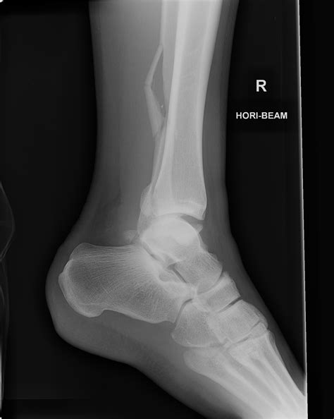 Child Ankle Xray Normal at Logan Lovelace blog