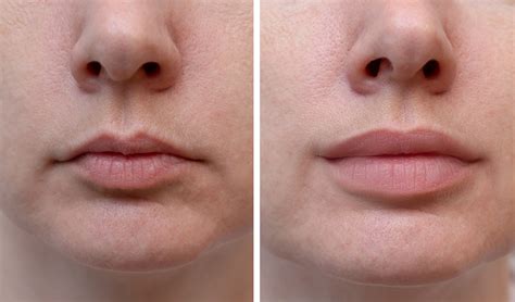 Lip Filler - Dr. Harinder S. Chahal MD