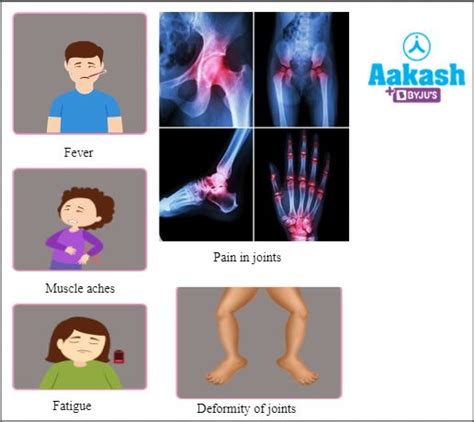 Arthritis Types, Causes, Symptoms, Treatments, Preventions, Practice ...