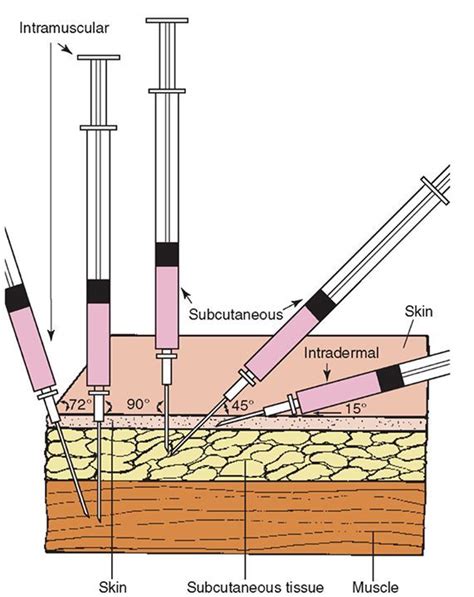All Types of Injection 的图像结果