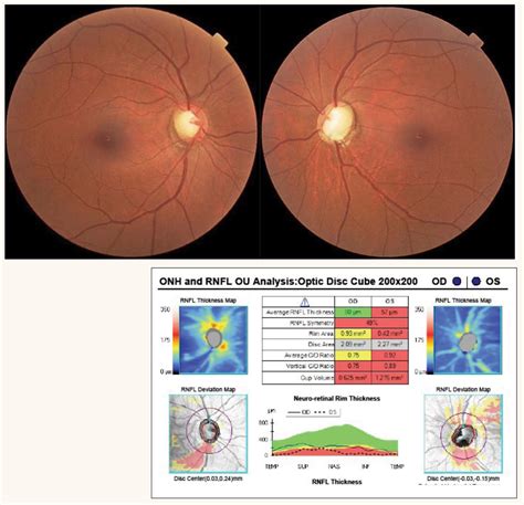 Optic Disc Disorder at Alyssa Camm blog