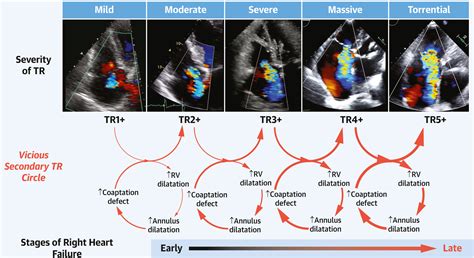 Tricuspid Valve Academic Research Consortium Definitions for Tricuspid Regurgitation and Trial ...