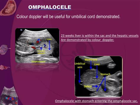 Umblical cord presentation | PPTX