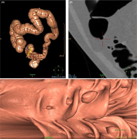 Image result for Colonoscopy Polyps Types